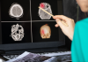 La detección temprana del infarto cerebrovascular: clave para salvar vidas